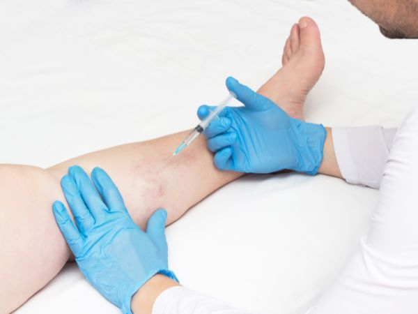 Pernas Leves e Lindas: Escleroterapia com até 12% de Desconto! 1 sessão por R$149,00 ou 3 por apenas R$399,00!