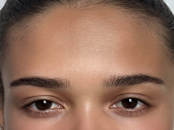 Botox em 3 regiões na Clínica Antolli